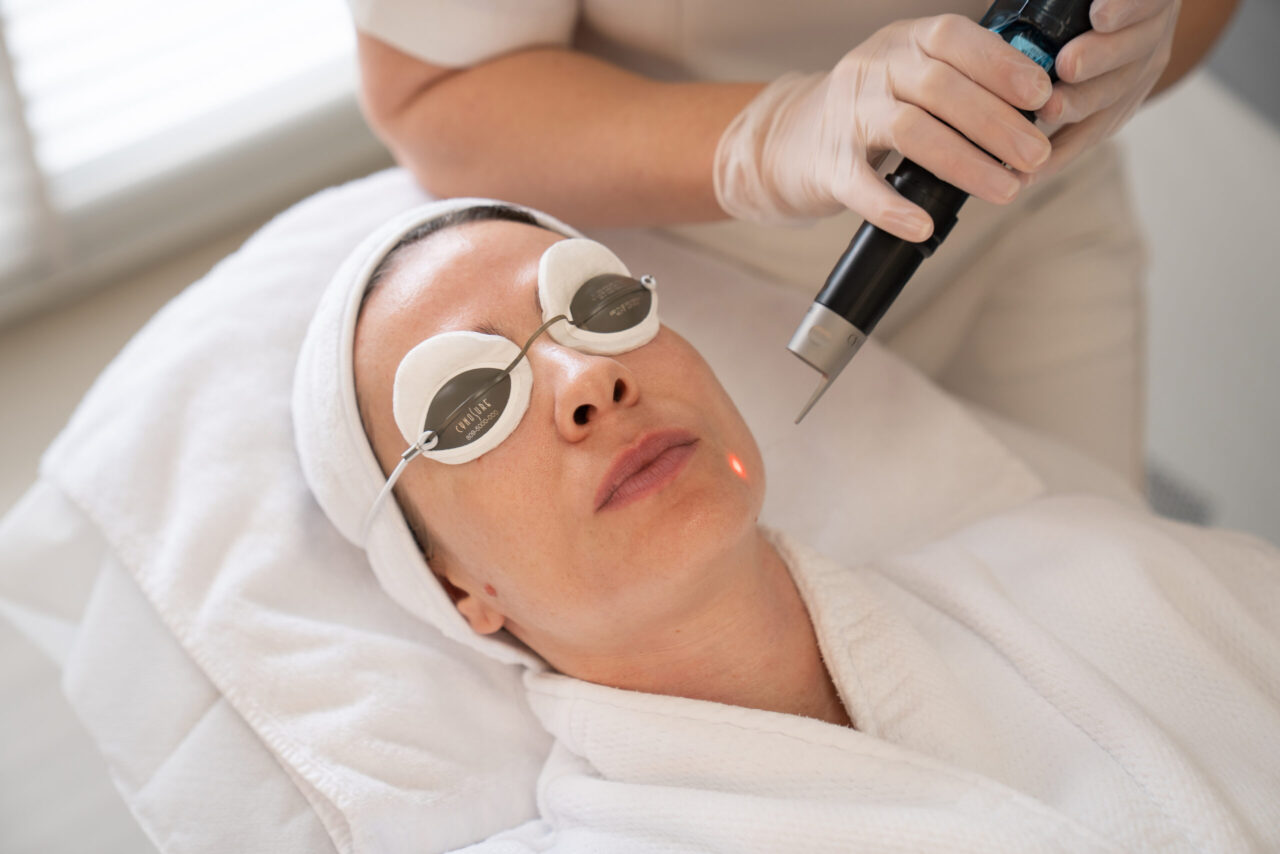 Pico laser treatment